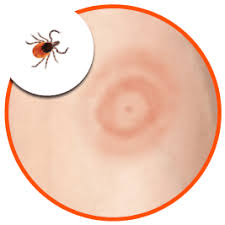 Lyme Disease and its Link to EMF